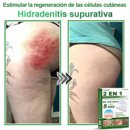 🇪🇸 Hudros® 😮‍💨 Parche 2 en 1 Microneedle Botanic 🧪| Eliminador de Lunares Elevados, Acné, Verrugas Planas y Pápulas de la Piel | Mejora Arrugas, Cicatrices y Manchas | Parches Invisibles para Espinillas en Cara y Cuerpo | 144 Unidades✨