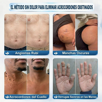 𝑻𝒓𝒊𝒍𝒖𝒎𝒊𝒂® 👨🏻‍⚕️ Bolígrafo Roller Premium | Eliminador de Verrugas, Lunares y Manchas 🇪🇸