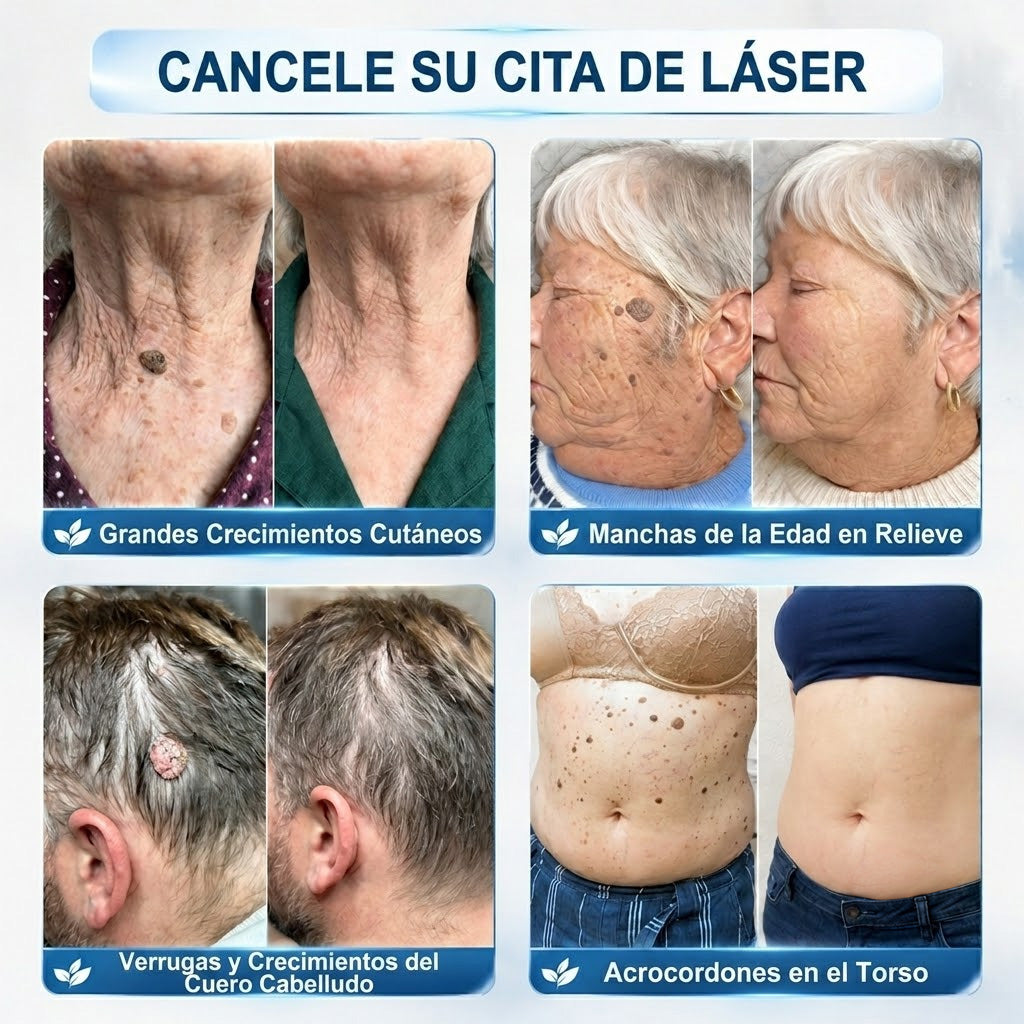 𝑻𝒓𝒊𝒍𝒖𝒎𝒊𝒂® 👨🏻‍⚕️ Bolígrafo Roller Premium | Eliminador de Verrugas, Lunares y Manchas 🇪🇸