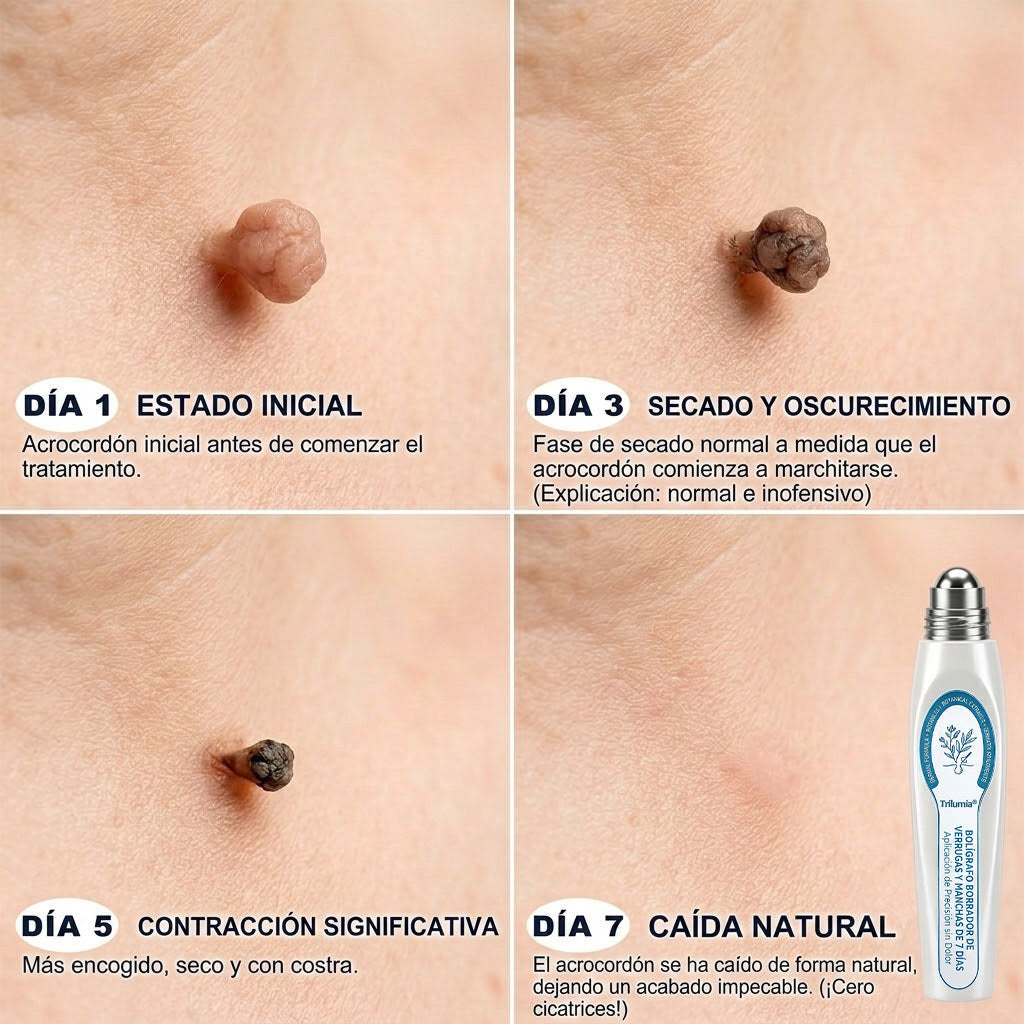 𝑻𝒓𝒊𝒍𝒖𝒎𝒊𝒂® 👨🏻‍⚕️ Bolígrafo Roller Premium | Eliminador de Verrugas, Lunares y Manchas 🇪🇸