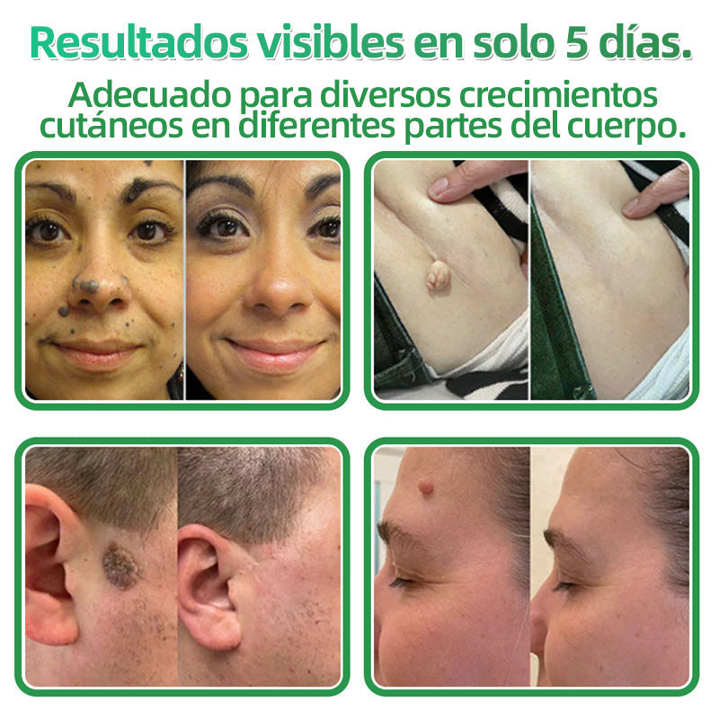 🇪🇸 Hudros® 😮‍💨 Parche 2 en 1 Microneedle Botanic 🧪| Eliminador de Lunares Elevados, Acné, Verrugas Planas y Pápulas de la Piel | Mejora Arrugas, Cicatrices y Manchas | Parches Invisibles para Espinillas en Cara y Cuerpo | 144 Unidades✨
