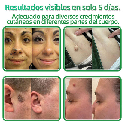 🇪🇸 Hudros® 😮‍💨 Parche 2 en 1 Microneedle Botanic 🧪| Eliminador de Lunares Elevados, Acné, Verrugas Planas y Pápulas de la Piel | Mejora Arrugas, Cicatrices y Manchas | Parches Invisibles para Espinillas en Cara y Cuerpo | 144 Unidades✨