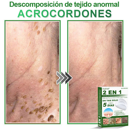 🇪🇸 Hudros® 😮‍💨 Parche 2 en 1 Microneedle Botanic 🧪| Eliminador de Lunares Elevados, Acné, Verrugas Planas y Pápulas de la Piel | Mejora Arrugas, Cicatrices y Manchas | Parches Invisibles para Espinillas en Cara y Cuerpo | 144 Unidades✨