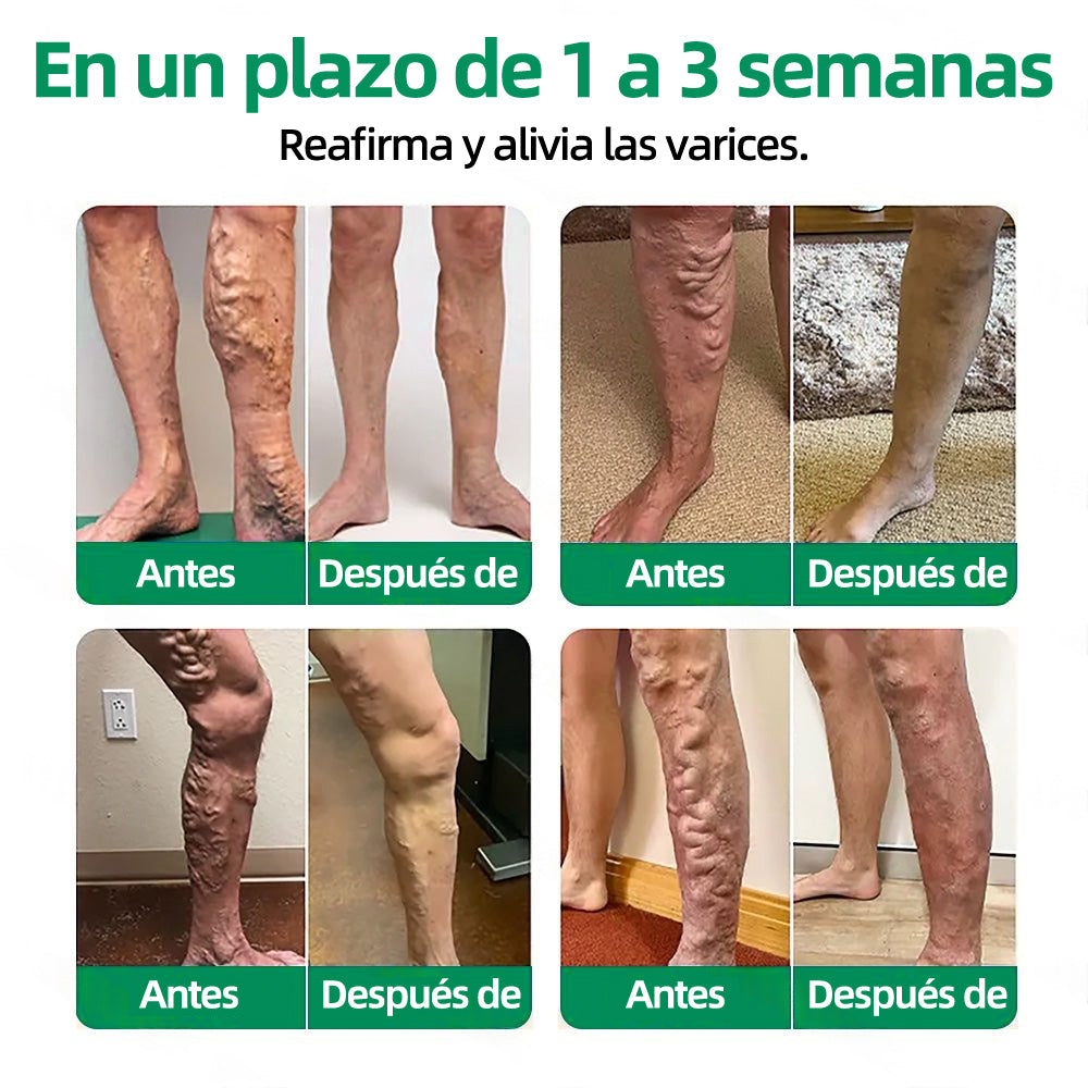 🇪🇸👨‍⚕️Parche de Microagujas Healrize® VeinTarget ✅ 🏆Alivio Instantáneo, Resultados a Largo Plazo