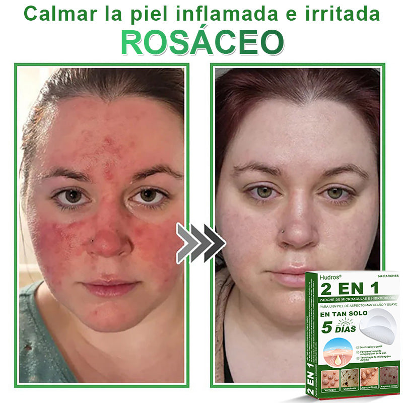 🇪🇸 Hudros® 😮‍💨 Parche 2 en 1 Microneedle Botanic 🧪| Eliminador de Lunares Elevados, Acné, Verrugas Planas y Pápulas de la Piel | Mejora Arrugas, Cicatrices y Manchas | Parches Invisibles para Espinillas en Cara y Cuerpo | 144 Unidades✨