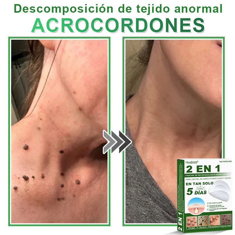 🇪🇸 Hudros® 😮‍💨 Parche 2 en 1 Microneedle Botanic 🧪| Eliminador de Lunares Elevados, Acné, Verrugas Planas y Pápulas de la Piel | Mejora Arrugas, Cicatrices y Manchas | Parches Invisibles para Espinillas en Cara y Cuerpo | 144 Unidades✨