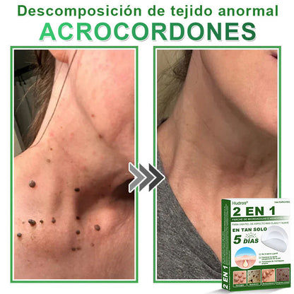 🇪🇸 Hudros® 😮‍💨 Parche 2 en 1 Microneedle Botanic 🧪| Eliminador de Lunares Elevados, Acné, Verrugas Planas y Pápulas de la Piel | Mejora Arrugas, Cicatrices y Manchas | Parches Invisibles para Espinillas en Cara y Cuerpo | 144 Unidades✨