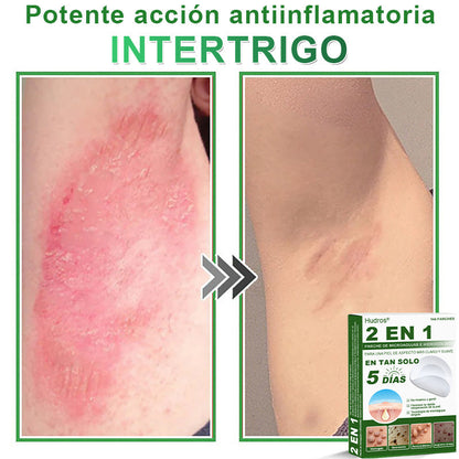 🇪🇸 Hudros® 😮‍💨 Parche 2 en 1 Microneedle Botanic 🧪| Eliminador de Lunares Elevados, Acné, Verrugas Planas y Pápulas de la Piel | Mejora Arrugas, Cicatrices y Manchas | Parches Invisibles para Espinillas en Cara y Cuerpo | 144 Unidades✨