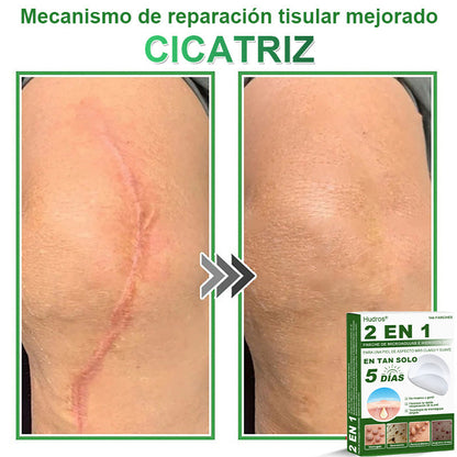 🇪🇸 Hudros® 😮‍💨 Parche 2 en 1 Microneedle Botanic 🧪| Eliminador de Lunares Elevados, Acné, Verrugas Planas y Pápulas de la Piel | Mejora Arrugas, Cicatrices y Manchas | Parches Invisibles para Espinillas en Cara y Cuerpo | 144 Unidades✨