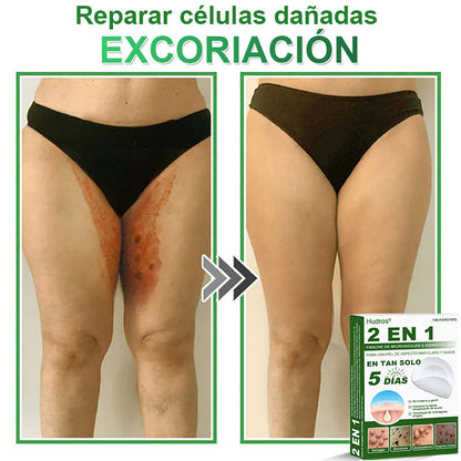 🇪🇸 Hudros® 😮‍💨 Parche 2 en 1 Microneedle Botanic 🧪| Eliminador de Lunares Elevados, Acné, Verrugas Planas y Pápulas de la Piel | Mejora Arrugas, Cicatrices y Manchas | Parches Invisibles para Espinillas en Cara y Cuerpo | 144 Unidades✨
